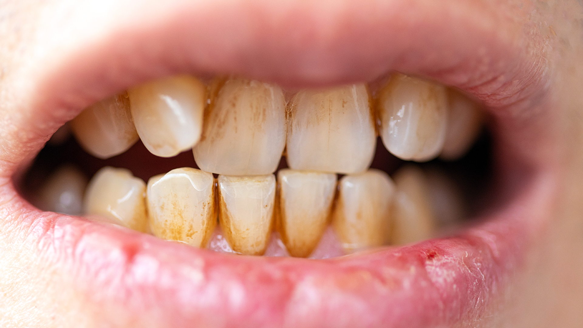 tandsteen 1280 tandplak