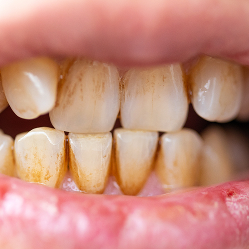 Last van gele of bruine tanden? Zo voorkom je tandaanslag en verkleuring