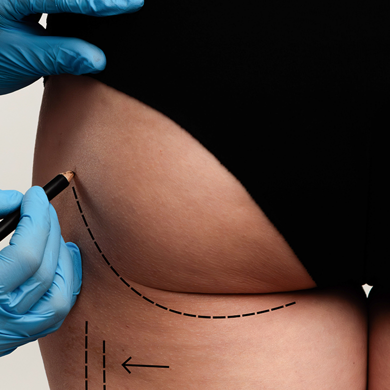 Afbeelding van Oproep: ging er iets mis bij een cosmetische ingreep in Turkije? Deel je verhaal met Kassa