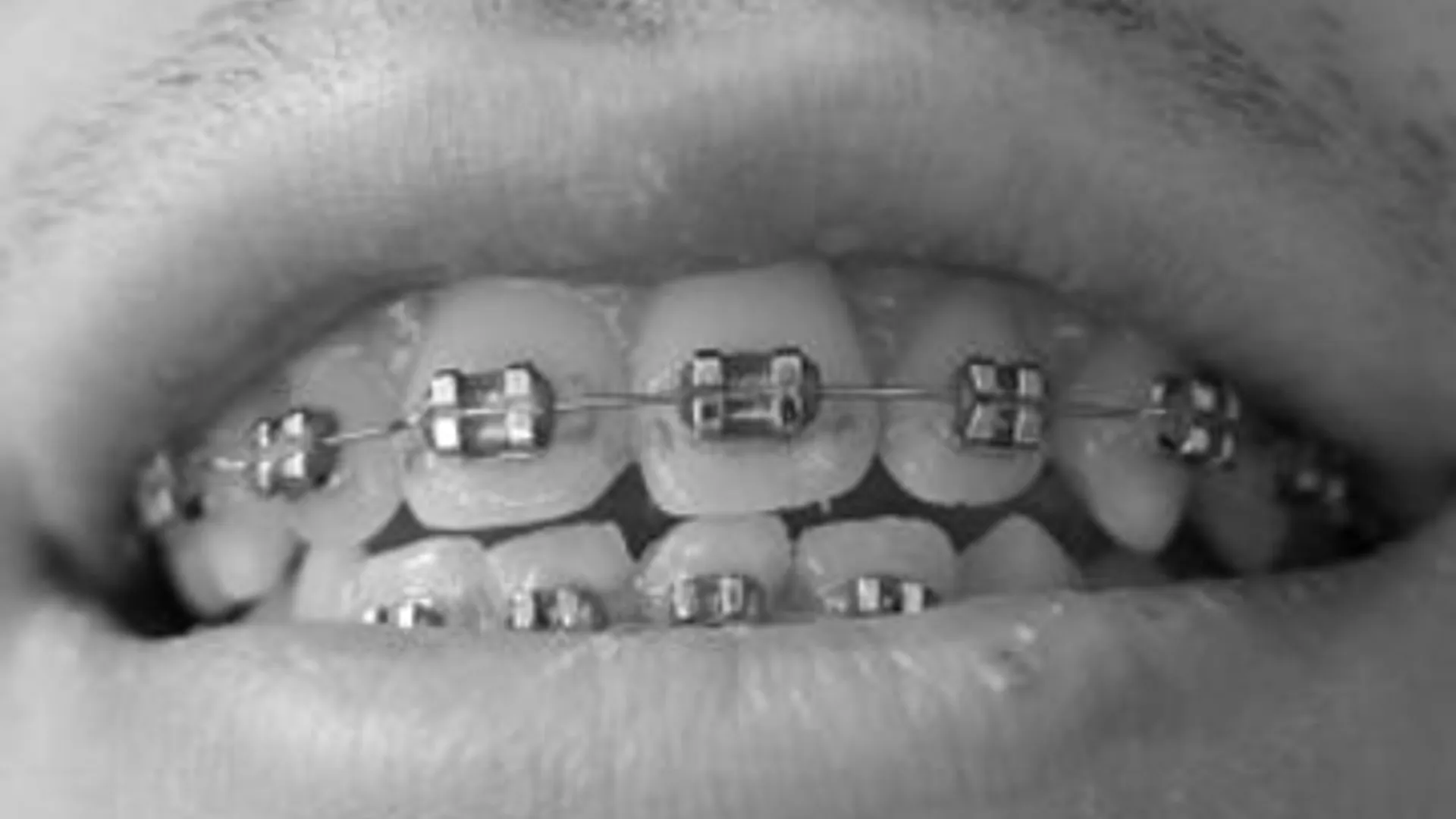 105810_braces.jpg
