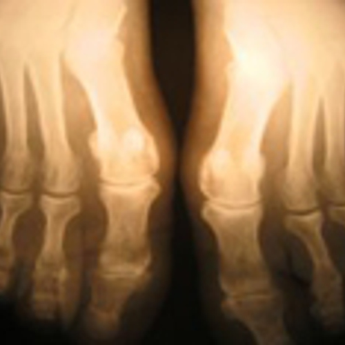 'Crohn-patiënten breken sneller botten'