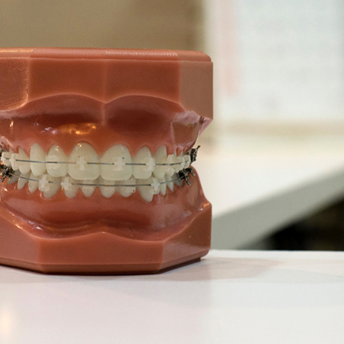 Bij vergoeding kinderorthodontie steeds vaker wachttijd