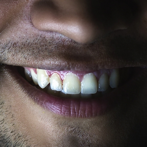 Extra coronakosten bij de tandarts en mondhygiënist: mag dat?